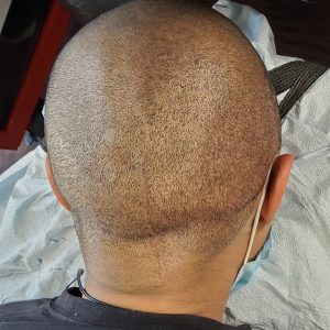 Hairline Tattoo and SMP Atist Danbury